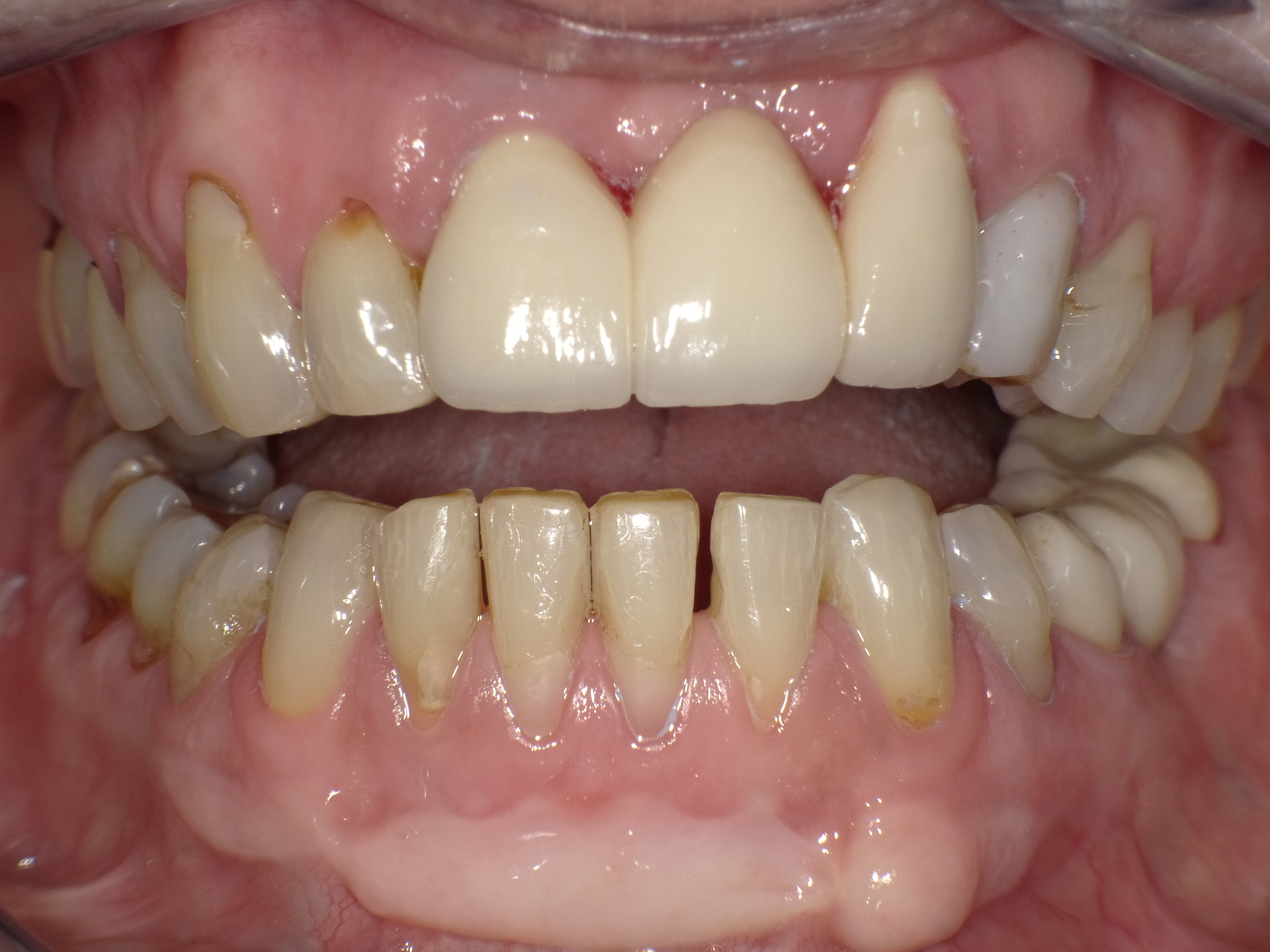 Diverse Vorbehandlungen mit für die Patientin absolut inakzeptablem Ergebnis